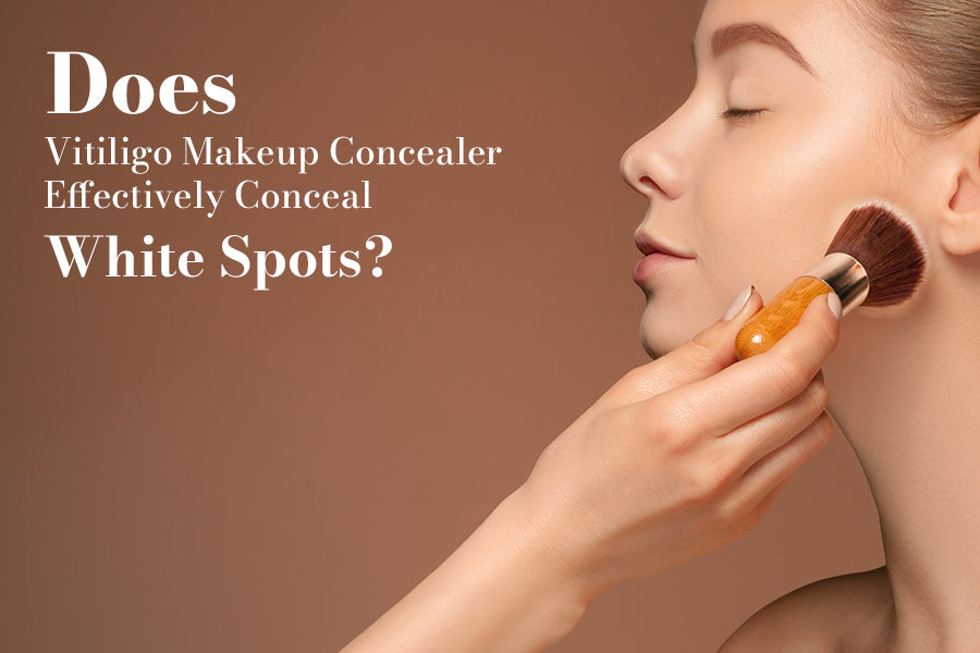 Does Vitiligo Makeup Concealer Effectively Conceal White Spots?