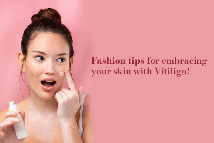 Fashion Tips For Embracing Your Skin With Vitiligo!