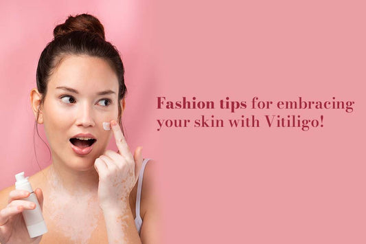 Fashion Tips For Embracing Your Skin With Vitiligo!