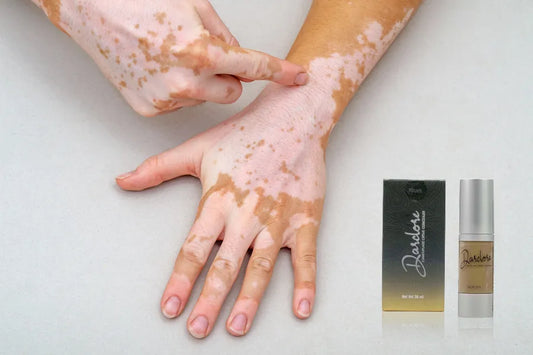 Why Darclore's Vitiligo Cream Is Best For Vitiligo Skin Coverage?