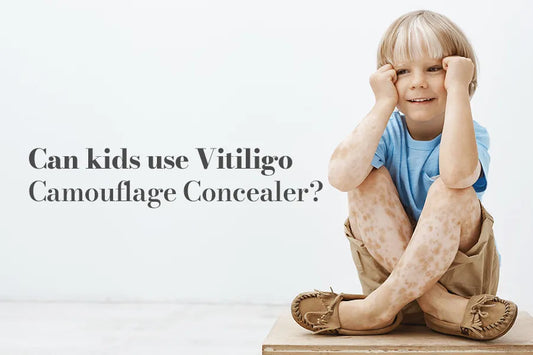 Can Kids Use Vitiligo Camouflage Concealer?