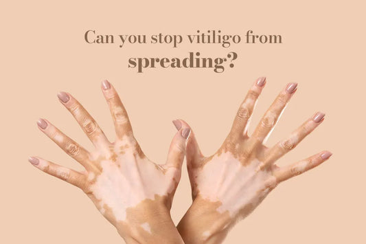 Can You Stop Vitiligo From Spreading?