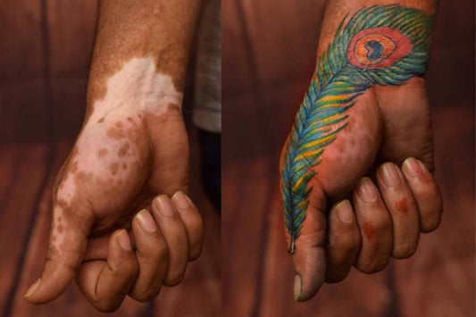 Covering Vitiligo With Tattoos: Feasible?