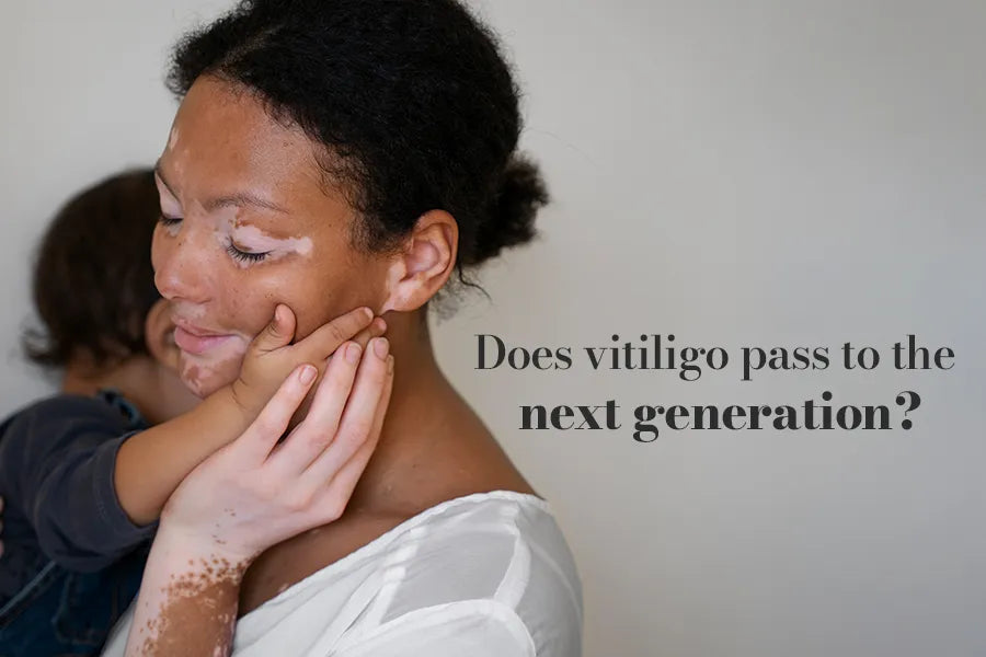 Does Vitiligo Pass to The Next Generation?