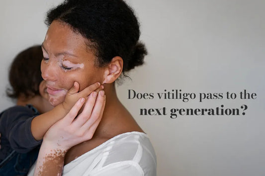 Does Vitiligo Pass to The Next Generation?