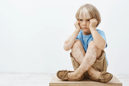 How To Teach Your Child Overcome The Fear Of Vitiligo?