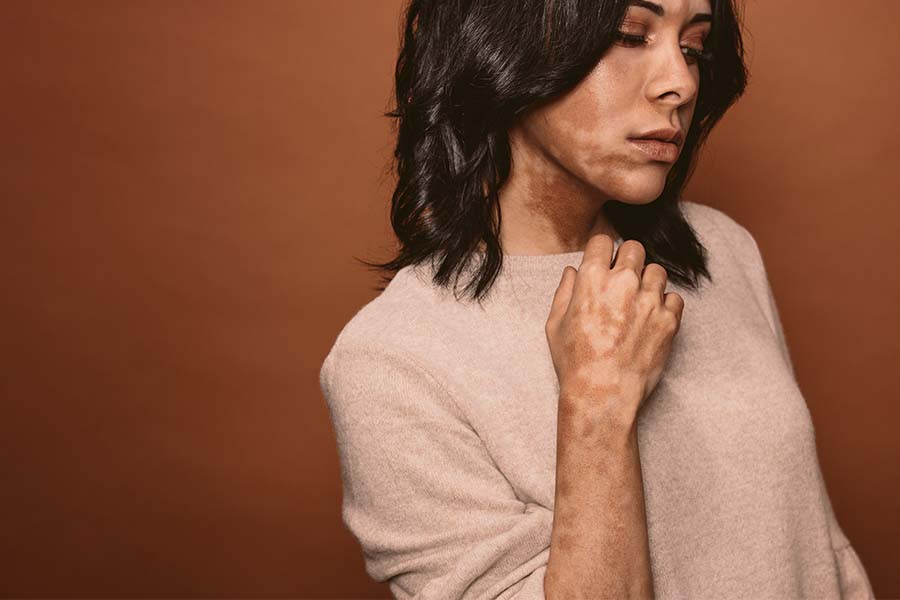 What Fabrics Are Best For Sensitive Skin With Vitiligo?
